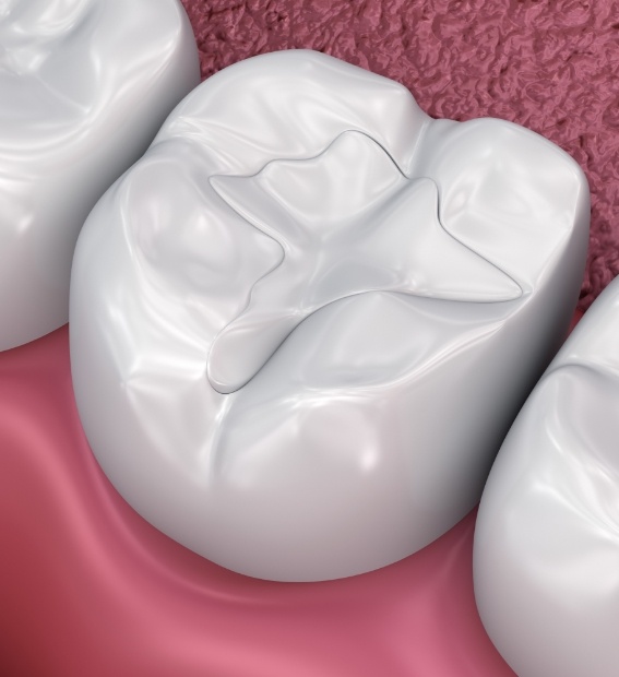 Animated smile with dental sealants