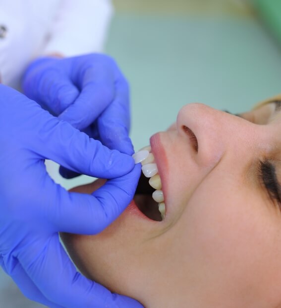 Woman's smile compared with cosmetic dental bonding color option
