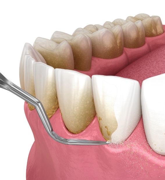 Animated smile during scaling and root planing periodontal therapy