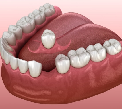 Animated smile during during single tooth replacement