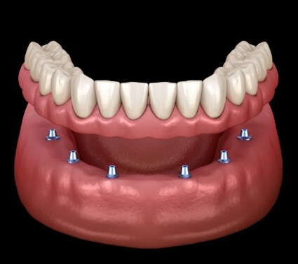 Animated smile during dental implant supported denture placement