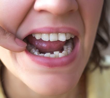 crowded teeth in need of Invisalign in Plano