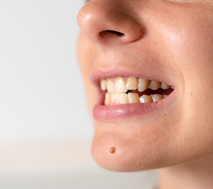 bite misalignment in need of Invisalign in Plano