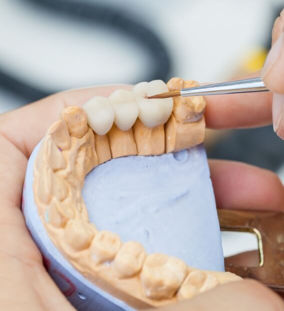 Model smile with dental bridge restoration