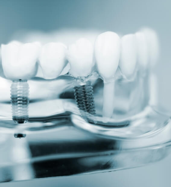 Model smile with dental implant supported dental crown