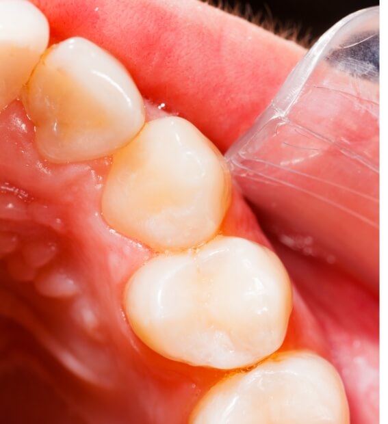 Closeup of flawless smile with tooth colored fillings after restorative dentistry treatment