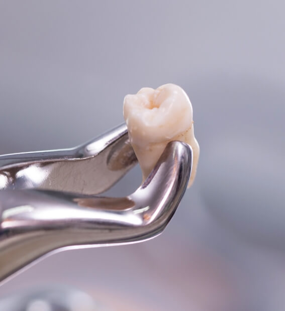 Metal clasp holding an extracted tooth