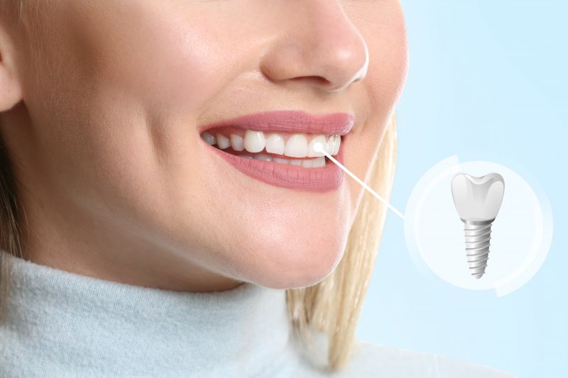 patient smiling after getting dental implants in Plano 